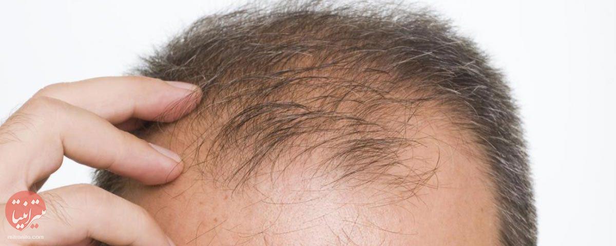 درمان ریزش مو - میترانیتا